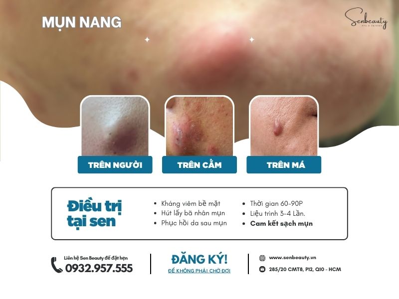 Trị các loại mụn nhọt trứng cá có cam kết